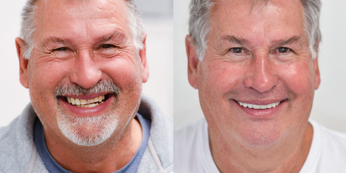 TEETH ON IMPLANTS® Before & After