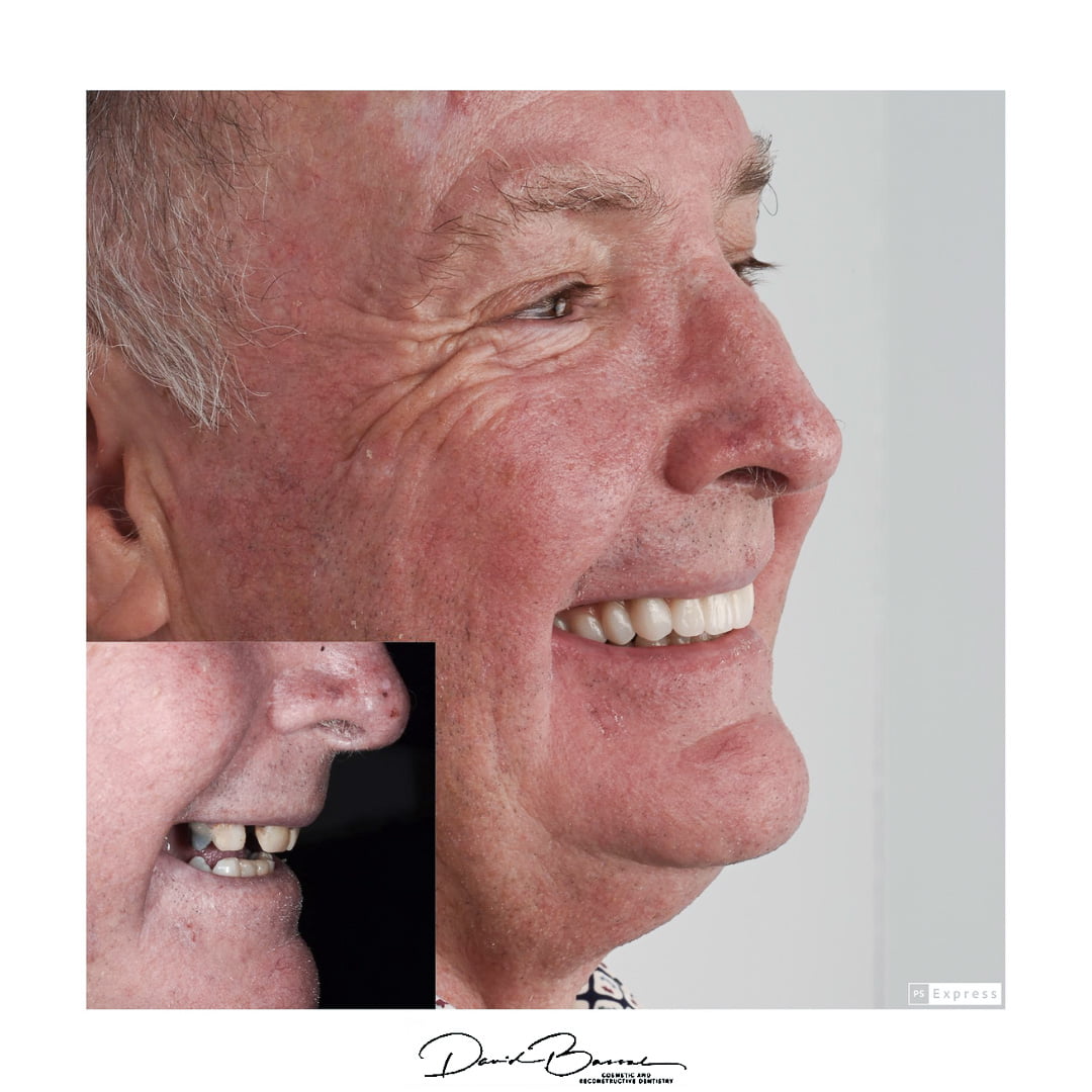 TEETH ON IMPLANTS® - Before and After
