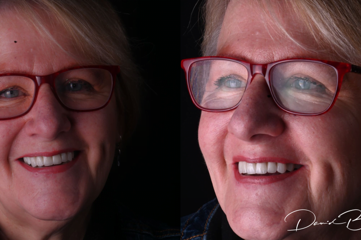 before and after teeth on implants dental implants