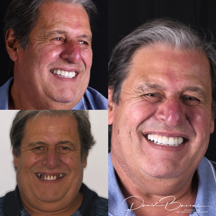 Ned Restom - Smile On Clinics - Teeth on Implant
