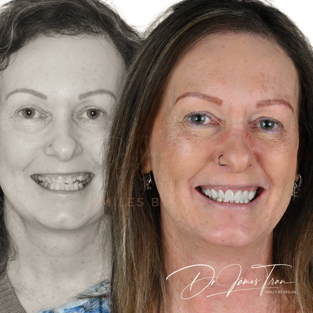 Dr James Tran's patient Lynette – Before and After