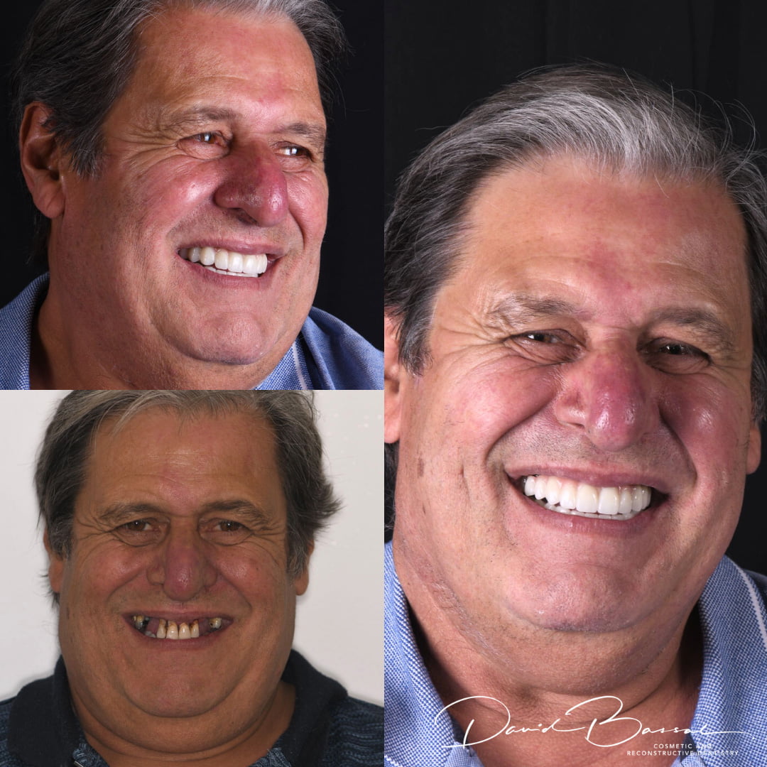 Dr David Bassal's Patient – Before and After
