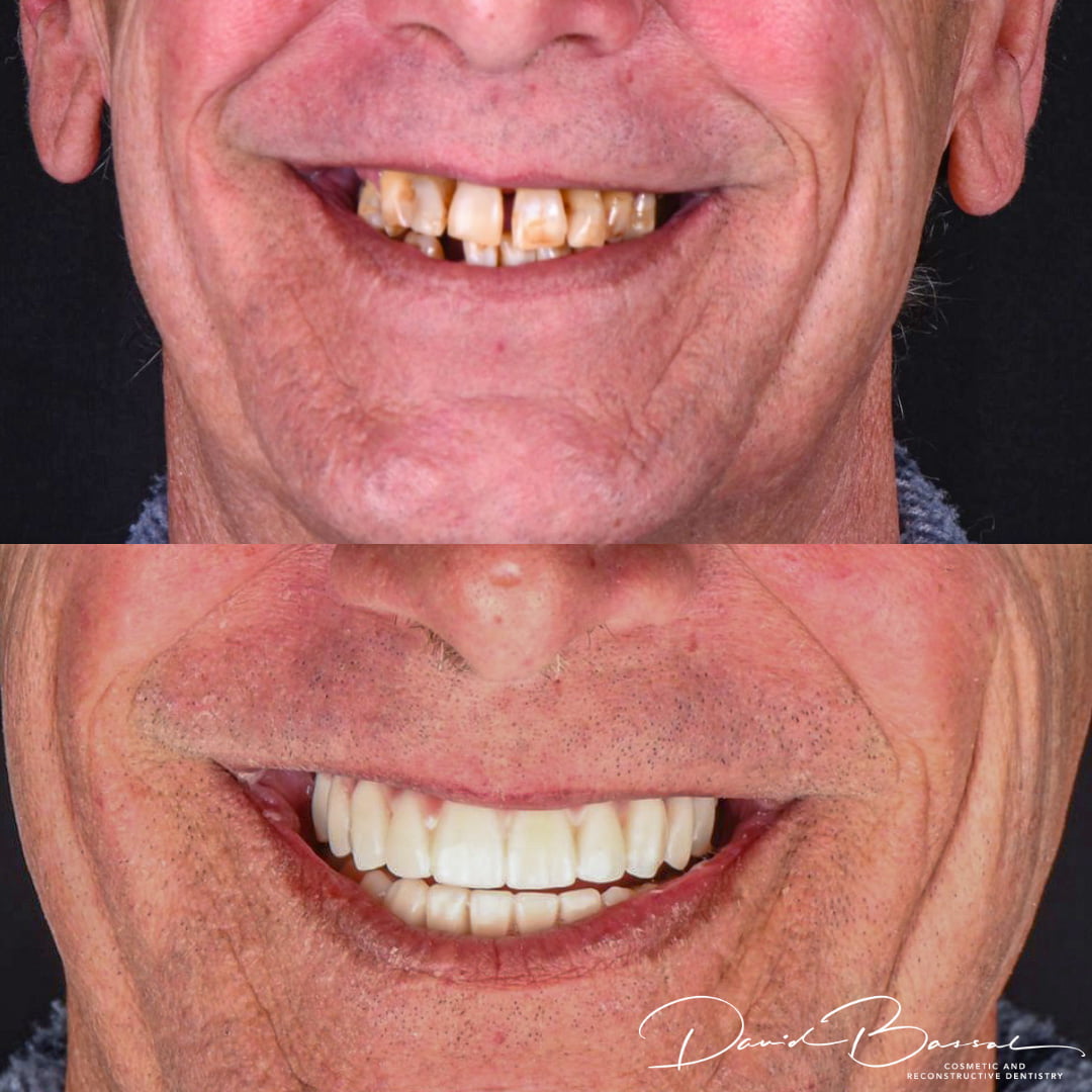 Dr David Bassal's Patient – Before and After Closeup