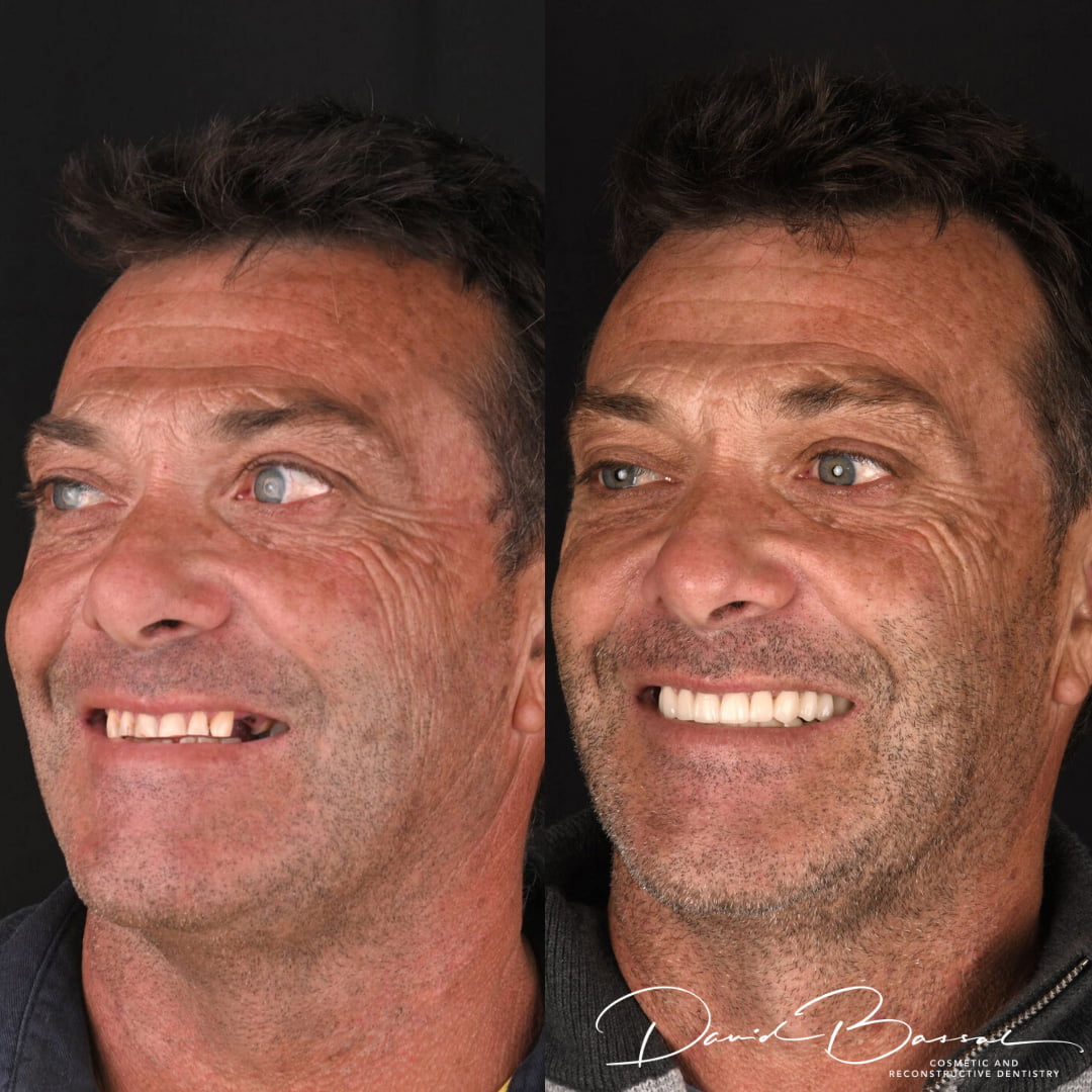 Dr David Bassal's Patient – Before and After Profile